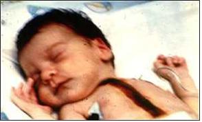 1984년, 생후 12일 만에 개코원숭이의 심장을 이식  받은 아기 파이(Fae). 레오나드 베일리 등이 수술을 담 당했으며, 시술 후 20일 동안 생존했다. ⓒ2012 HelloDD.com