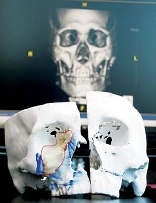 삼성서울병원은 국내 최초로 3D프린팅 기술을 이용, 부비동암 수술을 진행한 바 있다. 
