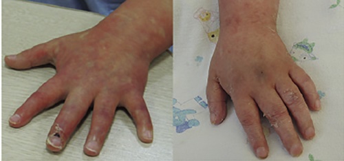 토파시티닙 투여 전의 환자 손의 상태(왼쪽)와 토파시티닙 투여후의 환자 손의 상태로 염증이 감소했음을 알 수 있다. <자료=GIST 제공>