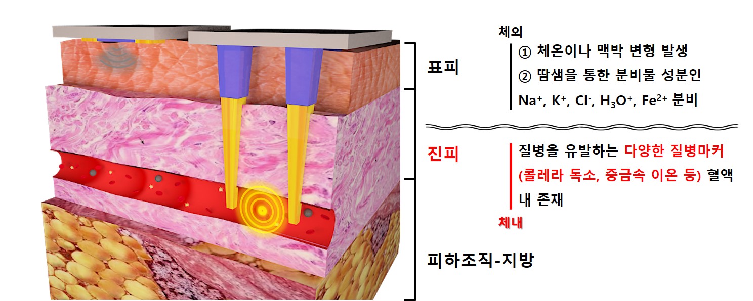 한국연구재단은 최헌진 교수 연구팀은 피부 속으로 침습해 혈액 내 질병 원인 물질을 진단하는 바이오센서를 개발했다고 18일 밝혔다. <사진=한국연구재단 제공>