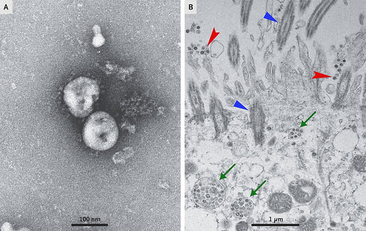 폐렴환자로부터 분리한 2019-nCoV를 투과전자현미경(TEM)으로 관찰한 이미지(A)와 2019-nCoV에 감염된 사람 호흡기 상피세포의 전자현미경 이미지(B). 섬모(파란색), 세포 외 바이러스입자(빨간색), 봉입체(바이러스 덩어리, 초록색)의 모습을 관찰할 수 있다. <사진=IBS 제공>