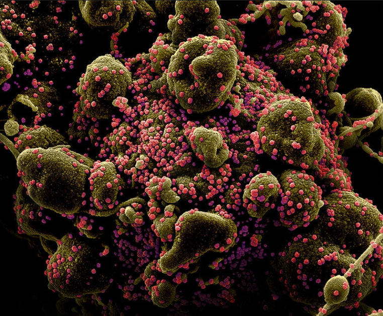 사스 코로나바이러스 입자(분홍색)에 심하게 감염된 사멸세포(녹색)의 전자 현미경 컬러 사진. <사진=NIH 홈페이지 갈무리>