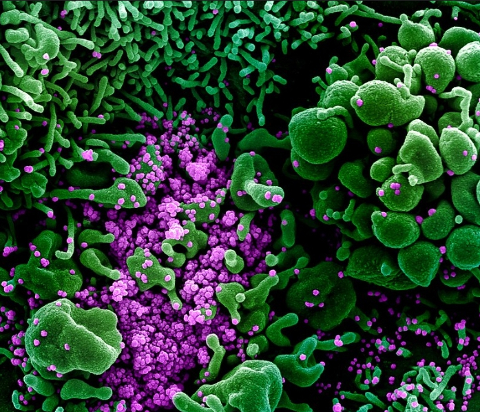 사스 코로나바이러스 입자(보라색)에 심하게 감염된 사멸세포(녹색)의 전자 현미경 컬러 사진. <사진=NIH 홈페이지 갈무리>