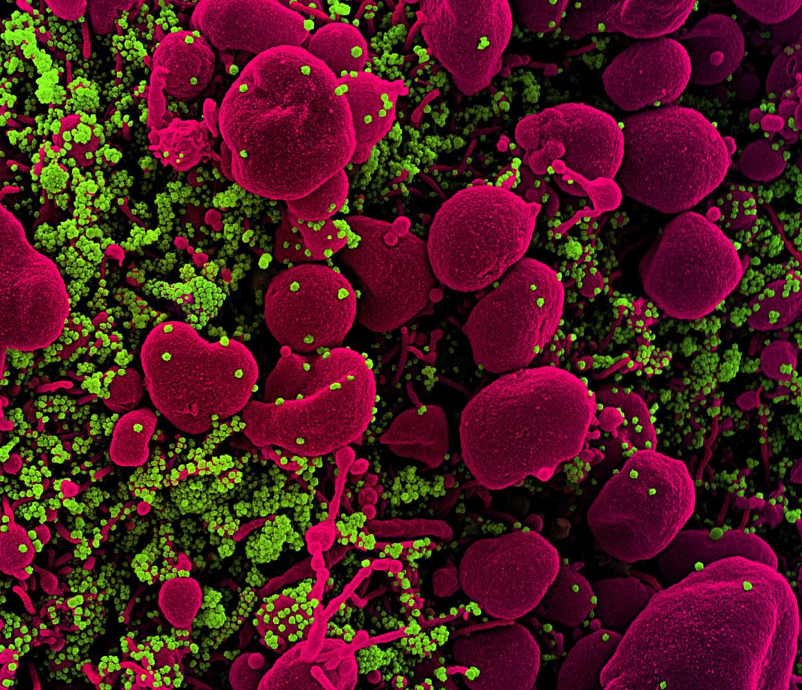 미국 국립알레르기·감염병연구소(NIAID) 연구진이 전자현미경으로 촬영한 코로나19 입자(녹색), 사멸되는 세포(apoptotic cell, 분홍색). <사진=미국국립보건연구원(NIH) 제공>