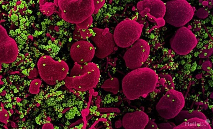 미국 국립알레르기·감염병연구소(NIAID) 연구진이 전자현미경으로 촬영한 코로나19 입자(녹색), 사멸되는 세포(apoptotic cell, 분홍색). <사진=미국국립보건연구원(NIH) 제공>